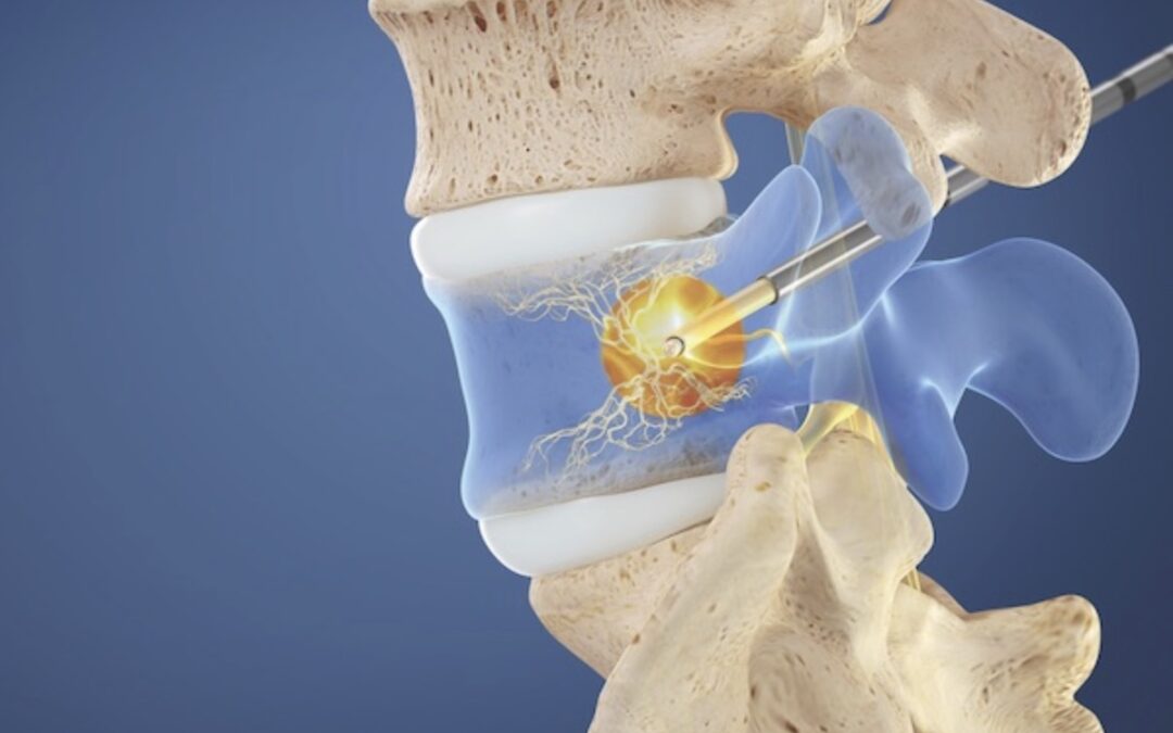 Intracept Procedure for Low Back Pain