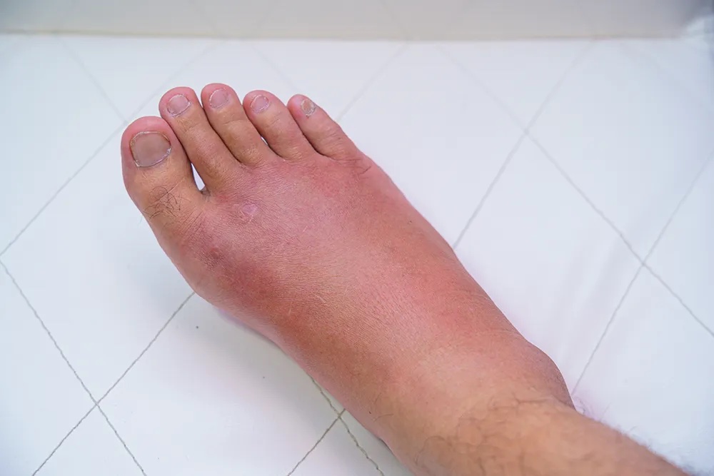 Complex Regional Pain Syndrome (CRPS)