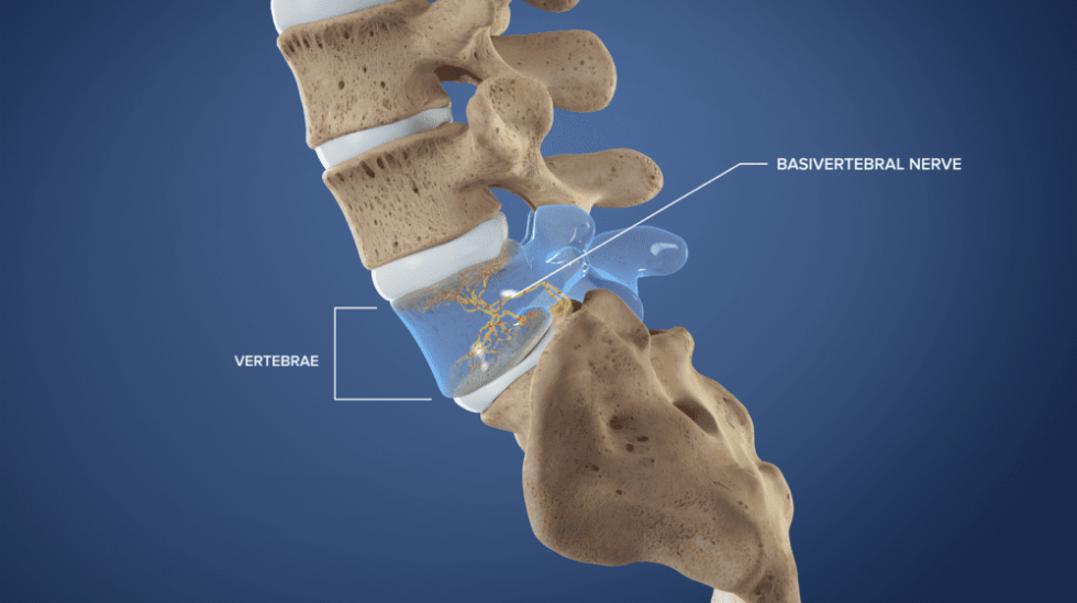 intracept-procedure-for-low-back-pain-advanced-spine-and-pain-clinic